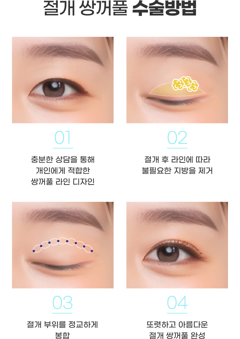 절개 쌍꺼풀 수술방법