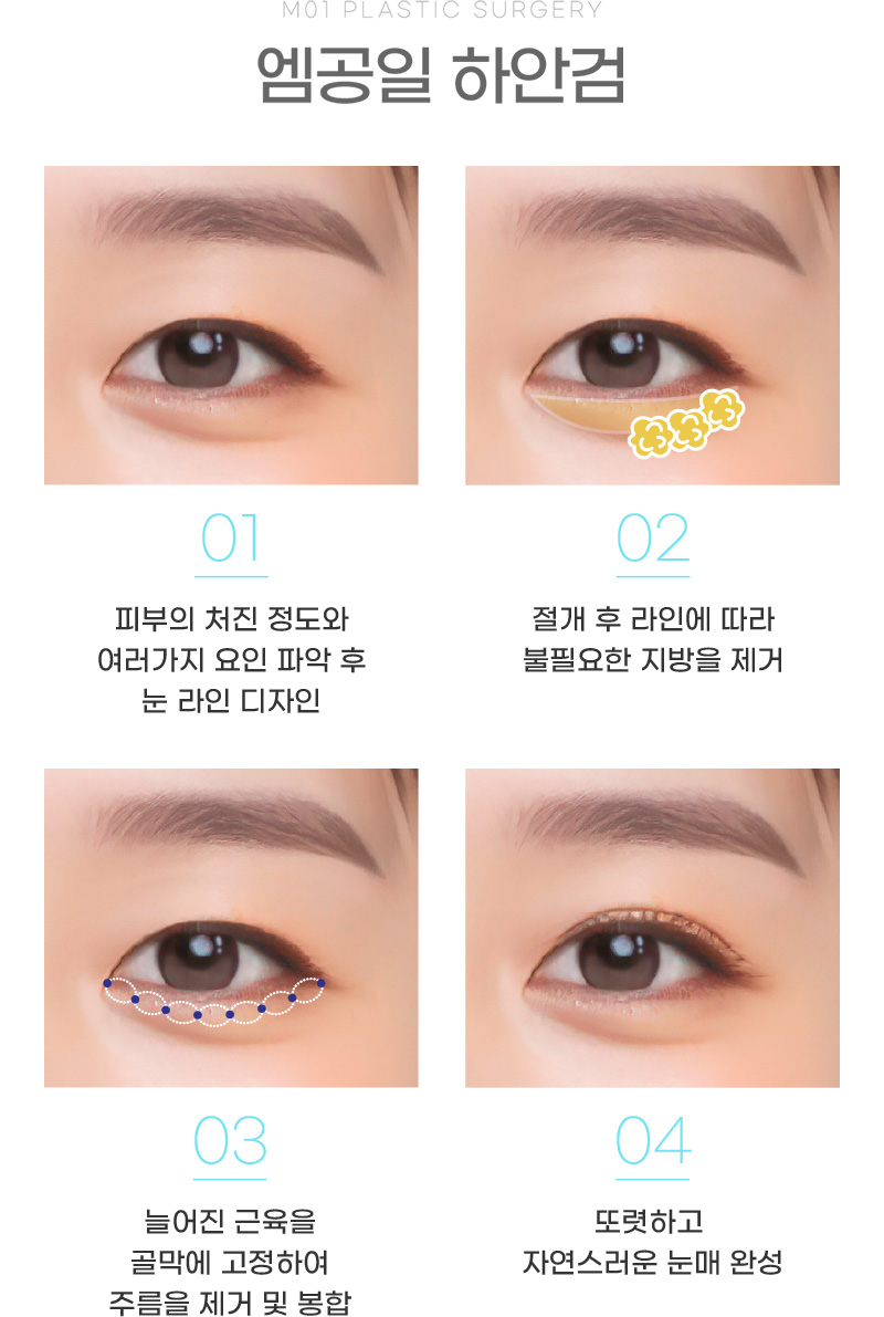 엠공일 하안검 누구에게 효과적일까?