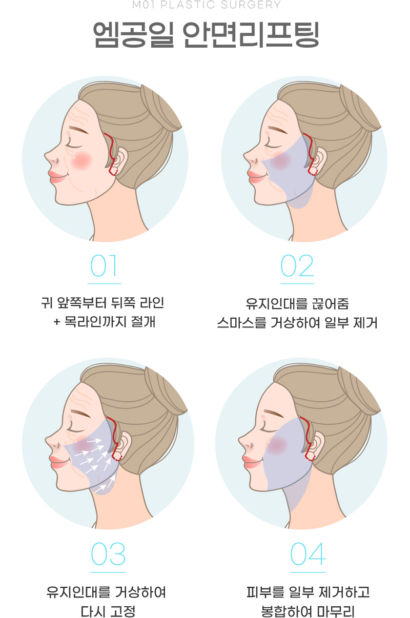엠공일 안면리프팅