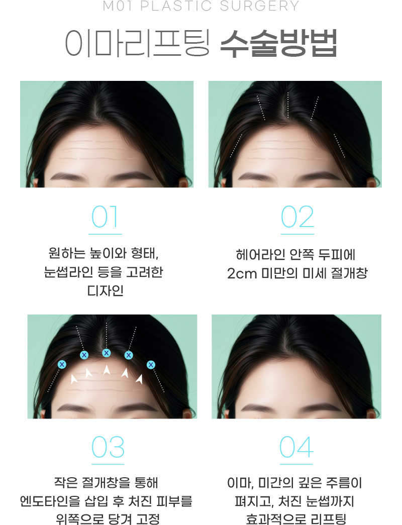 이마리프팅 수술방법