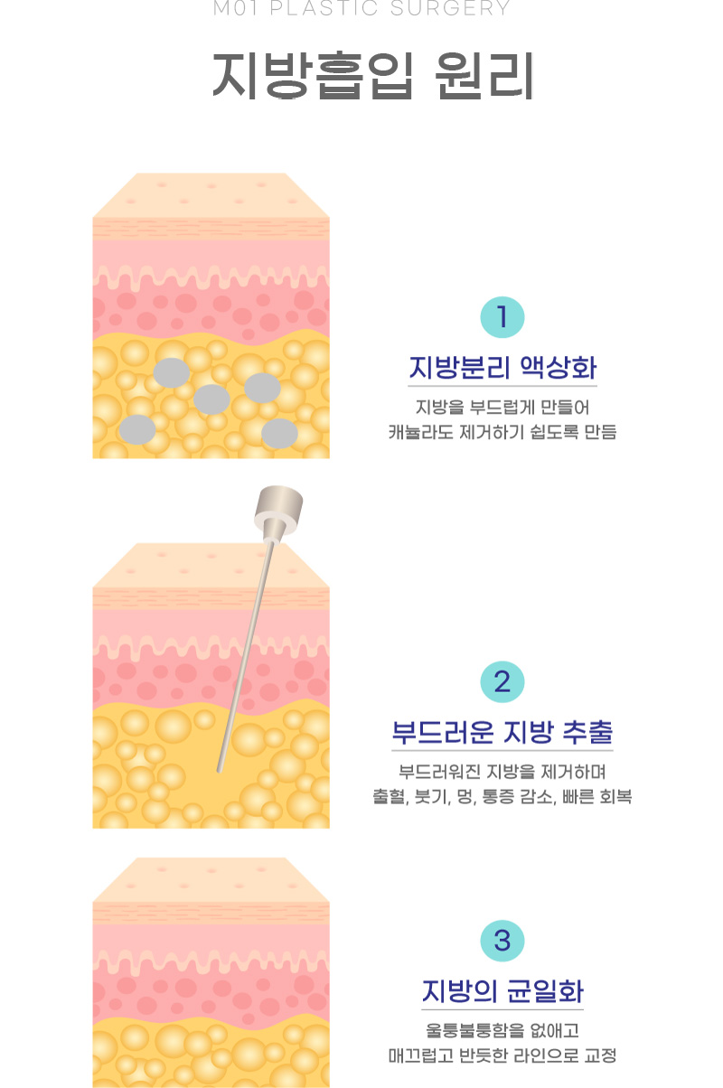 지방흡입 원리