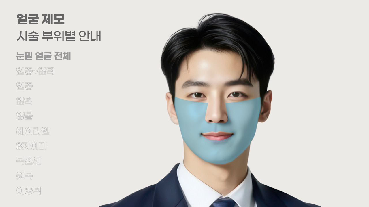 얼굴제모 시술 부위별 안내-1