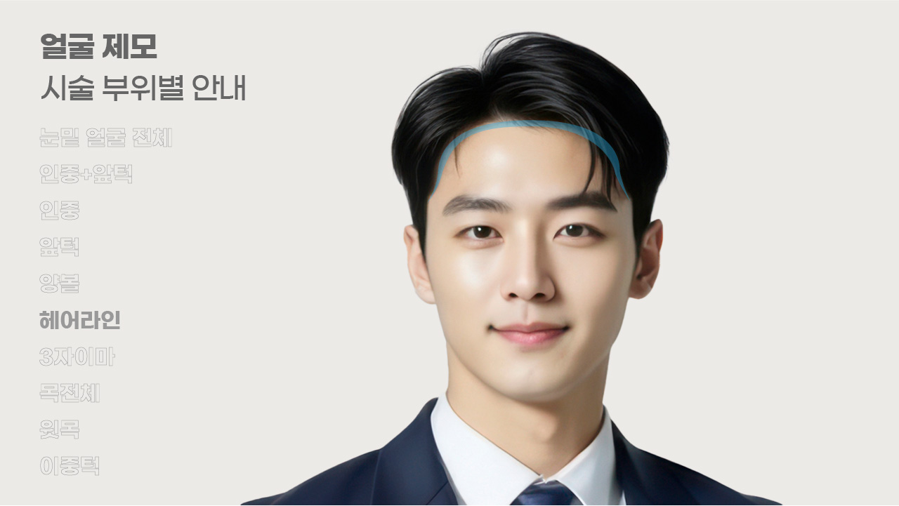 얼굴제모 시술 부위별 안내-6