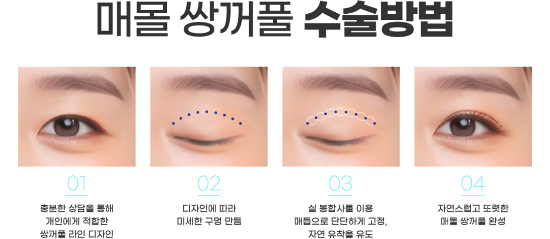 매몰 쌍꺼풀 수술방법