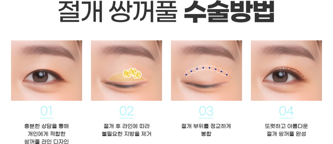 절개 쌍꺼풀 수술방법