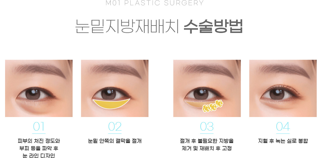 눈밑지방재배치 수술방법