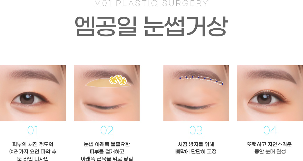 엠공일 눈썹거상