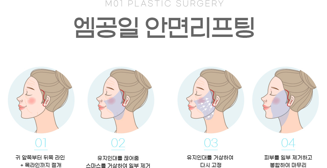 엠공일 안면리프팅