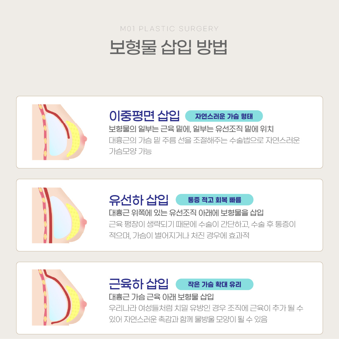 보형물 삽입방법