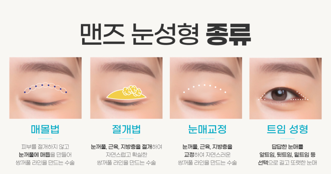 맨즈 눈성형 종류